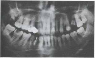 Рис. 1а. Ортопантомограмма пациента А. Генерализованное поражение костной ткани альвеолярных отростков, зоны резорбции не имеют четких границ, что свидетельствует об активности процесса; убыль костной ткани составляет более 2/3 длины корней, подцесневые зубные отложения