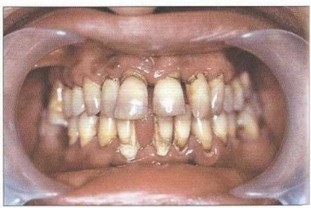 Рис. 28. Флюороз l-И степени, множественный пришеечный кариес, аномалия положения зубов на верхней и нижней челюстях, отсутствие 31